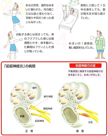 メニエール 病 診断