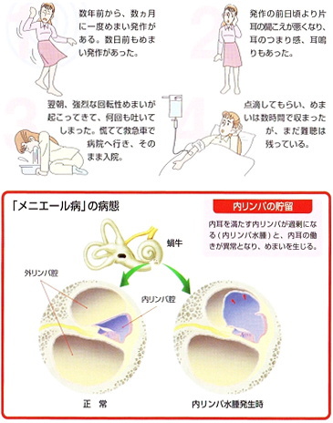 病 食事 メニエール